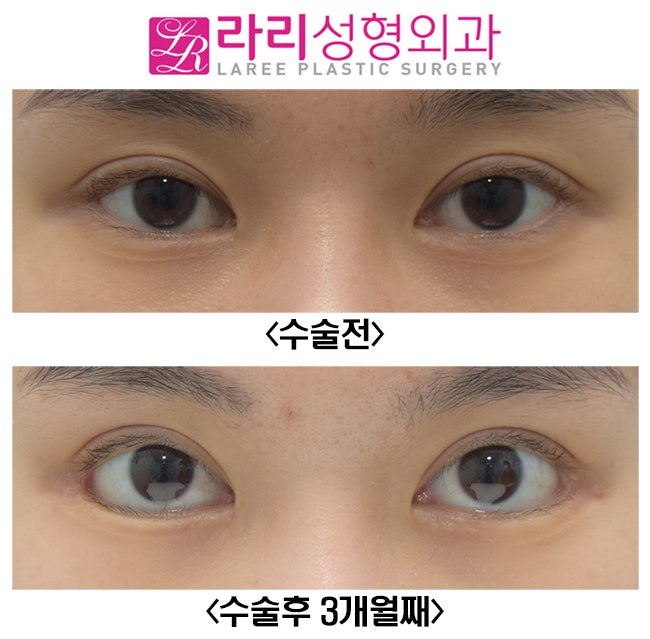 [라리성형외과] 효과 확실한 눈꼬리내리기뒤트임수술 단기 경과 전후 사진 관련 이미지 1