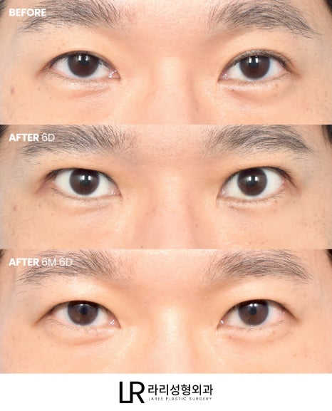[Lari Plastic Surgery] Swelling After Double Eyelid Surgery: Why Does It Go Down Differently on Each Side? Will It Eventually Even Out? image 5