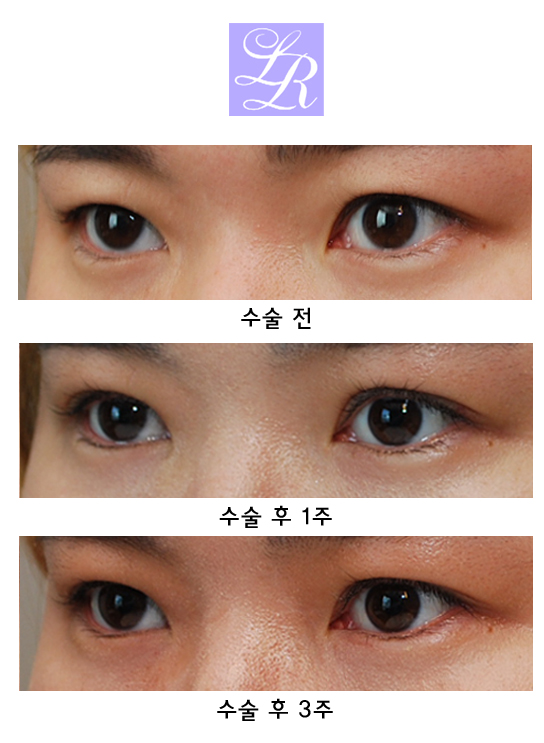 비절개눈매교정 - 미세 눈 비대칭 짝짝이 교정 관련 이미지 6