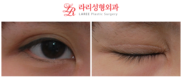 Restoration of Epicanthoplasty and Removal of Sunken Double Eyelid Scars image 1