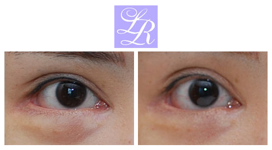 If You Want an S-Line Under Your Eyes, Try Lower Eye Widening image 3