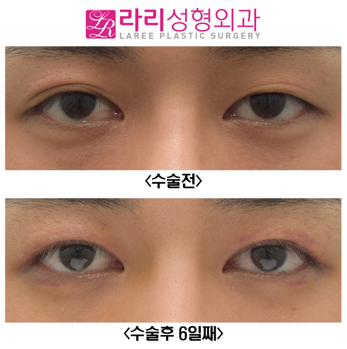 [라리성형외과] 쌍꺼풀없애는수술 전후사진 일주일이면 실밥 제거 관련 이미지 1