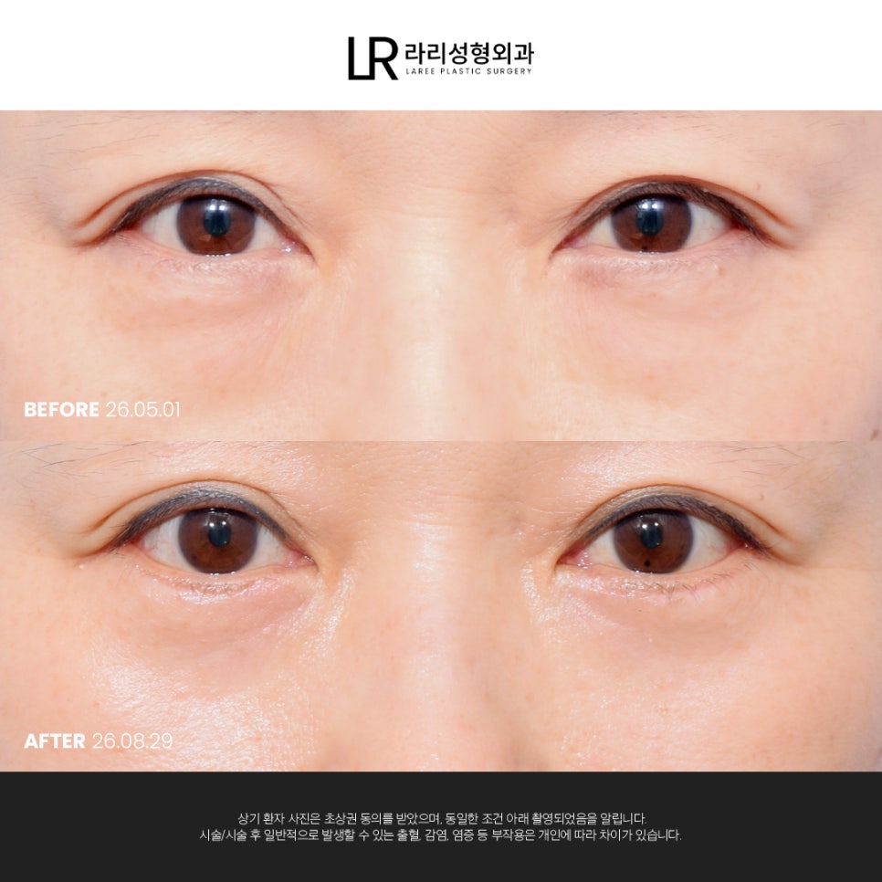 [라리성형외과] 눈 밑이 피곤해 보이는데 눈 밑에 지방만 빼면 될까?(눈밑지방재배치수술 VS 하안검수술) 관련 이미지 3