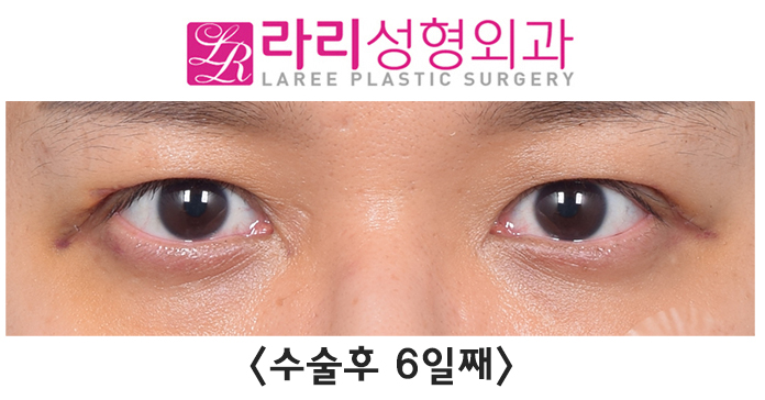 [라리성형외과] 쌍꺼풀없애기수술은 쌍꺼풀을 없애주는 겁니다. 관련 이미지 2