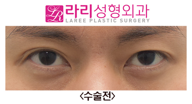 [Rari Plastic Surgery] Before and After Right Non-incisional Double Eyelid Reoperation image 1