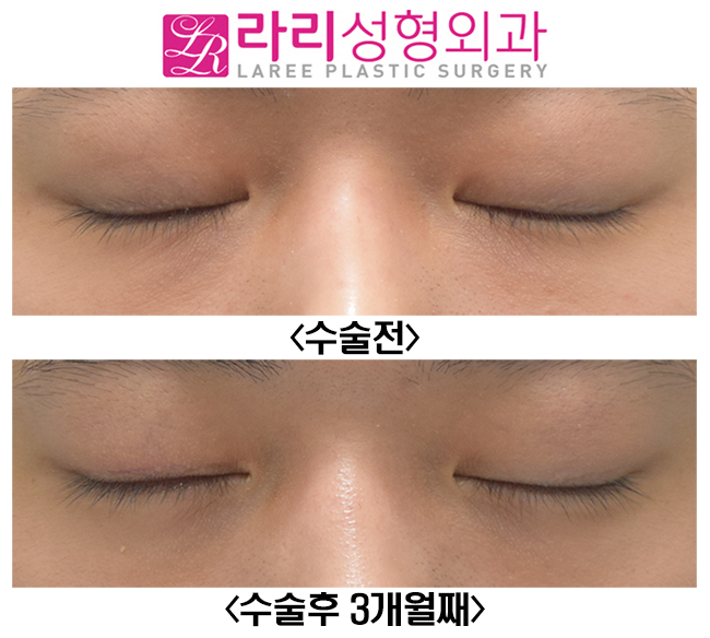 [라리성형외과] 한쪽 쌍수? 한쪽쌍꺼풀없애기? 반대쪽에 쌍꺼풀이 생겨요 관련 이미지 4