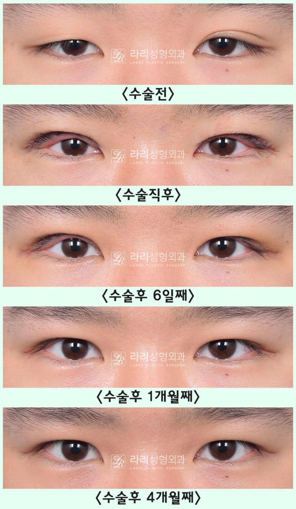 [Lari Plastic Surgery] Removing a Visible Double Eyelid (Double Eyelid Reversal Surgery), From Natural Double Eyelids to Surgical Double Eyelids: A to Z image 22