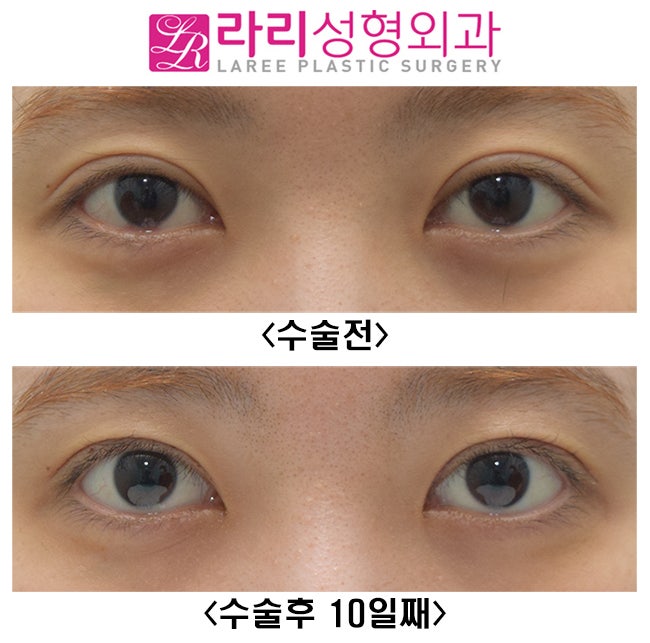 [Lari Plastic Surgery] Double Eyelid Revision Surgery with Line Lowering Combined with Ptosis Correction Surgery image 2