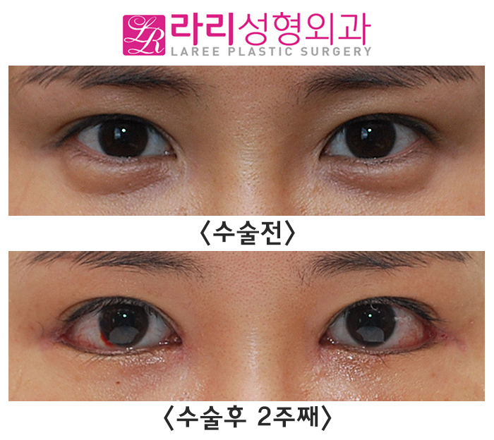 [Rari Plastic Surgery] Medial Canthoplasty Reoperation, Lateral Canthoplasty: Short-Term Progress on the Day of Stitch Removal Before and After Surgery image 1