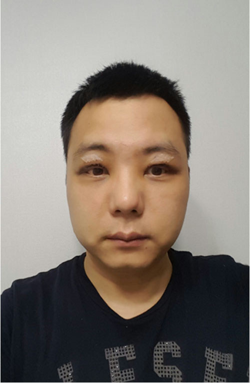 쌍꺼풀없애기 "나 대세임? " 관련 이미지 5