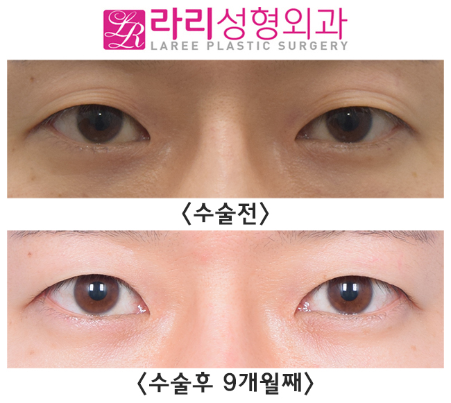 [라리성형외과] 무쌍으로 쌍꺼풀까지 없애는 절개눈매교정 관련 이미지 1