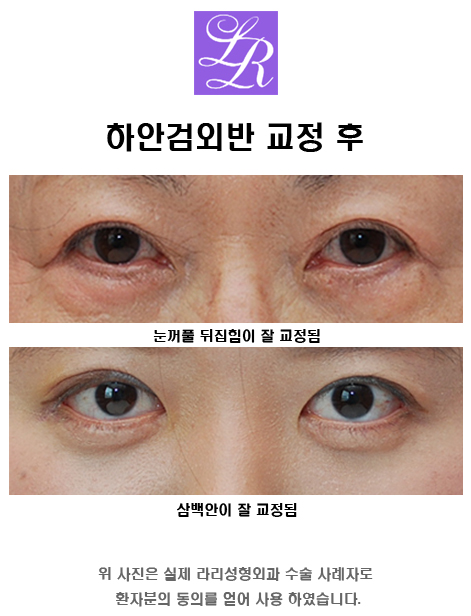 Will lower eye corner surgery or lower blepharoplasty side effects cause ectropion? image 4