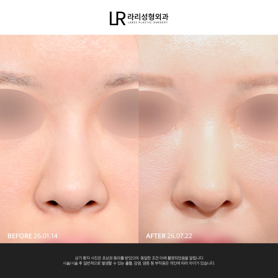 [LARI Plastic Surgery] Structural Line Rhinoplasty Revision Connecting the Nasal Bridge, Dorsum, and Tip image 3