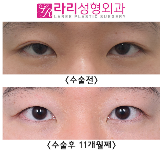 [Lari Plastic Surgery] Triple Set: Asymmetric Eye Correction + Ptosis Correction + Removing Double Eyelids! image 1