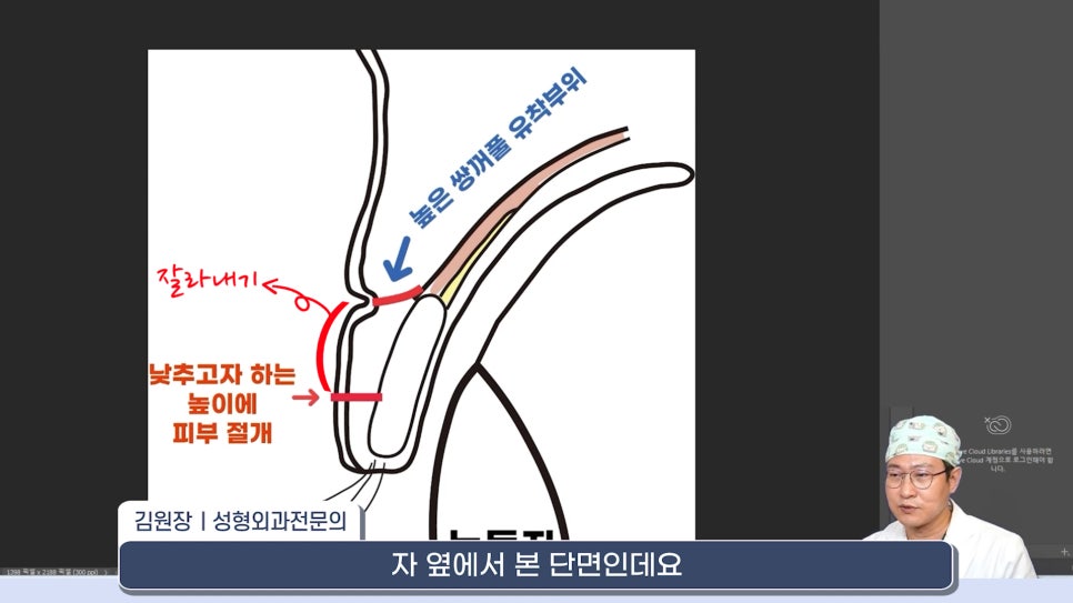 [라리성형외과] 쌍꺼풀재수술 라인 낮추는 두 가지 수술법 (절제방법 , 두줄따기방법) 관련 이미지 3
