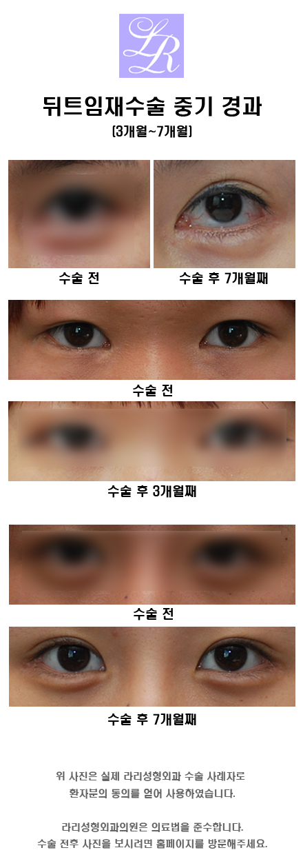 Revision Lateral Canthoplasty: Short-Term, Mid-Term, and Long-Term Progress (feat. Lari) image 2