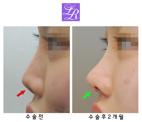 Short Upturned Nose Revision Surgery: Rib Cartilage Is Essential! (feat. Alar Reduction) image 2