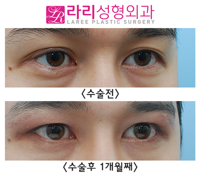 [라리성형외과] 겹쌍꺼풀 처진 눈 쌍꺼풀없애기, 그리고 눈썹하거상수술 전후 효과 관련 이미지 3