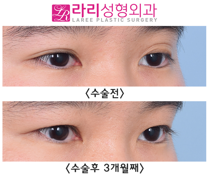 [라리성형외과] 쌍꺼풀 있어도 흐리멍텅한 눈 vs 쌍꺼풀 없어도 똘망똘망한 눈 관련 이미지 4
