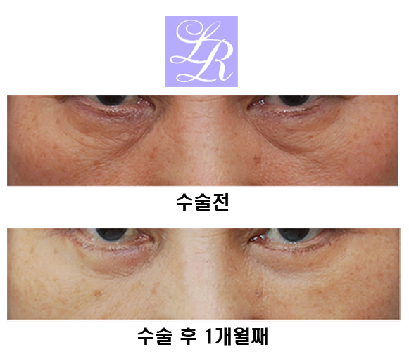 하안검수술,잘 알고 시행해야 관련 이미지 2
