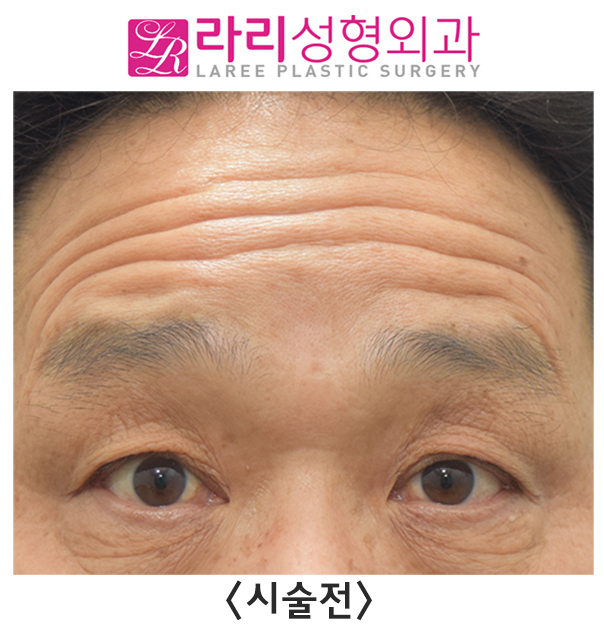 [라리성형외과] 이마 보톡스 효과 전후 사진 이마주름 얼마나 좋아지나 관련 이미지 2