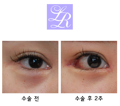 Can medial canthoplasty revision, lateral canthoplasty revision, and under-eye fat repositioning be done at the same time? image 4