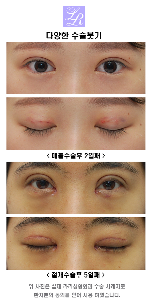 자연유착 쌍꺼풀잘하는곳, 다양한 케이스를 보여준다면 관련 이미지 2