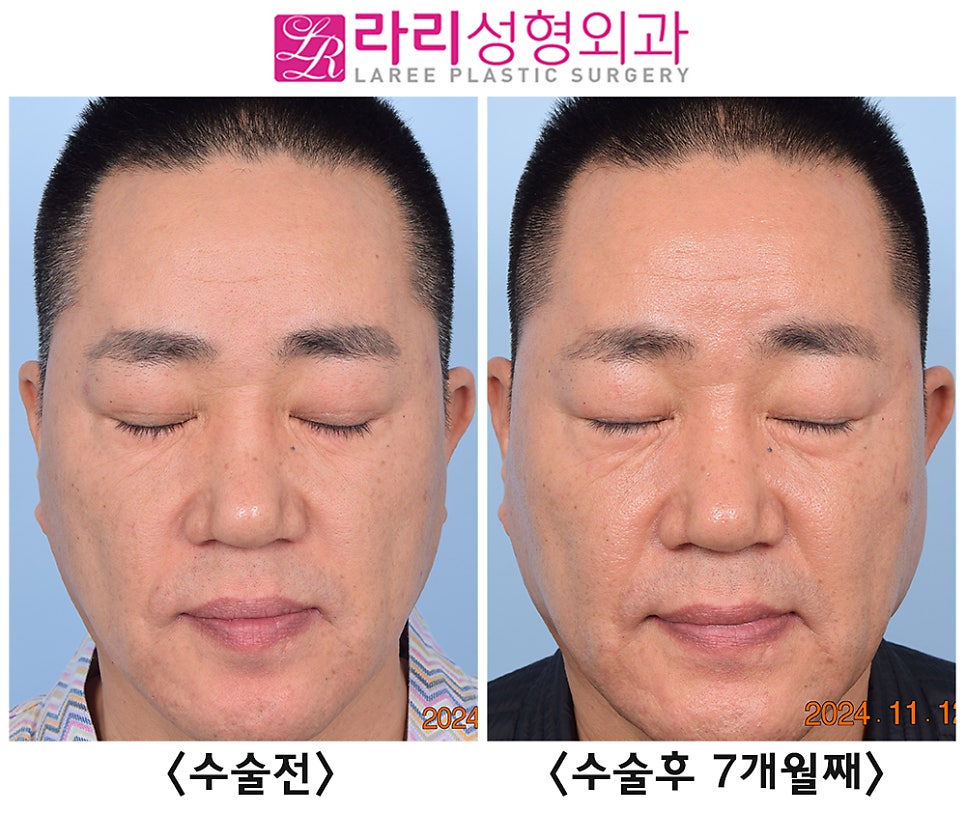 [Rari Plastic Surgery] Comparing Before and After Photos of Double Eyelid Removal Surgery (Double Eyelid Disappearance + Mucosal Ptosis Correction) image 5