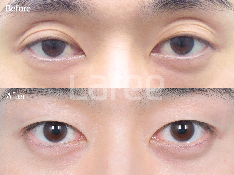 [Lari Plastic Surgery] Everything About Double Eyelid Removal Surgery image 3