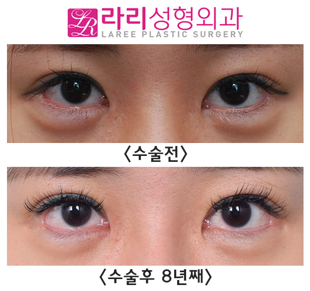 [Lari Plastic Surgery] Canthoplasty Reoperation for Lowering the Outer Corner of the Eyes: Before-and-After Photos Over More Than 8 Years of Long-Term Follow-Up image 1