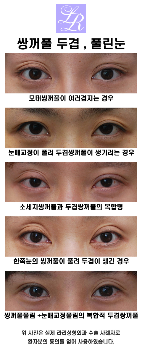 Double Eyelids, Especially When One Eye Has a Double Eyelid image 1