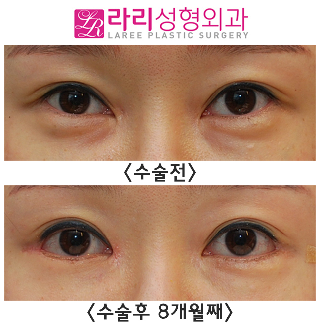 [Lali Plastic Surgery] Comparison Photos of the Before-and-After Differences of Epicanthoplasty Restoration, Revision Lateral Canthoplasty, and Fat Graft Removal Surgery (Under-Eye + Cheekbone Area) image 1
