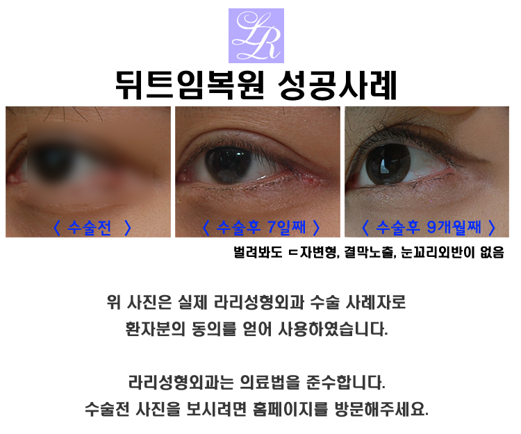 Where is the best place for revision canthoplasty? image 5
