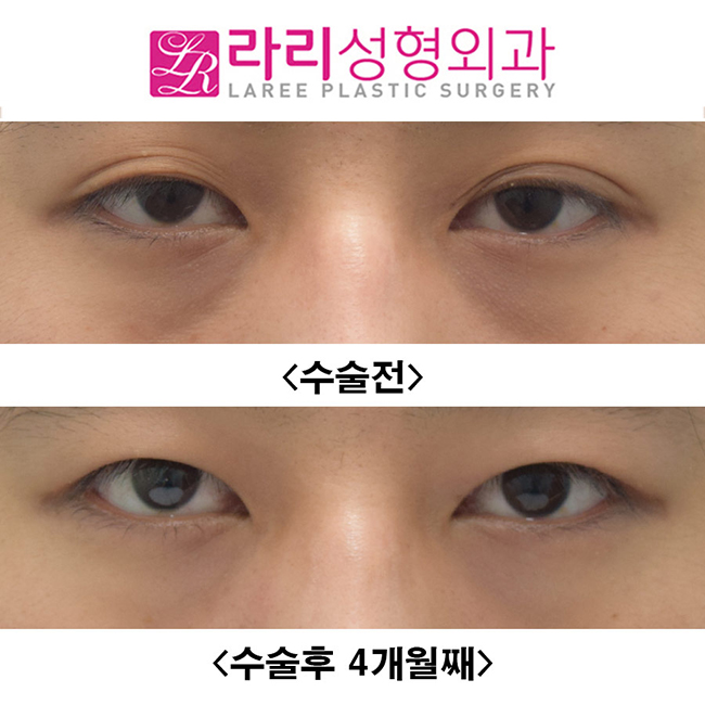 [라리성형외과] 눈이 작아지지 않으면서 쌍꺼풀없애는수술 전후사진 관련 이미지 1