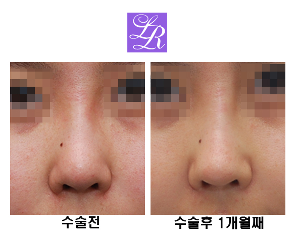 코재수술 코끝을 오똑하게 관련 이미지 1