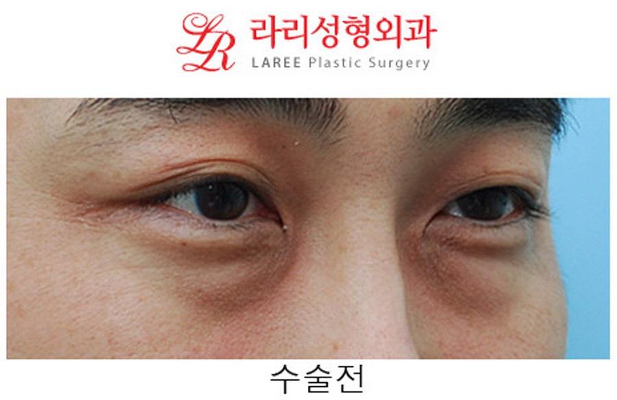 Under-Eye Fat Repositioning Before and After in Your 40s image 5