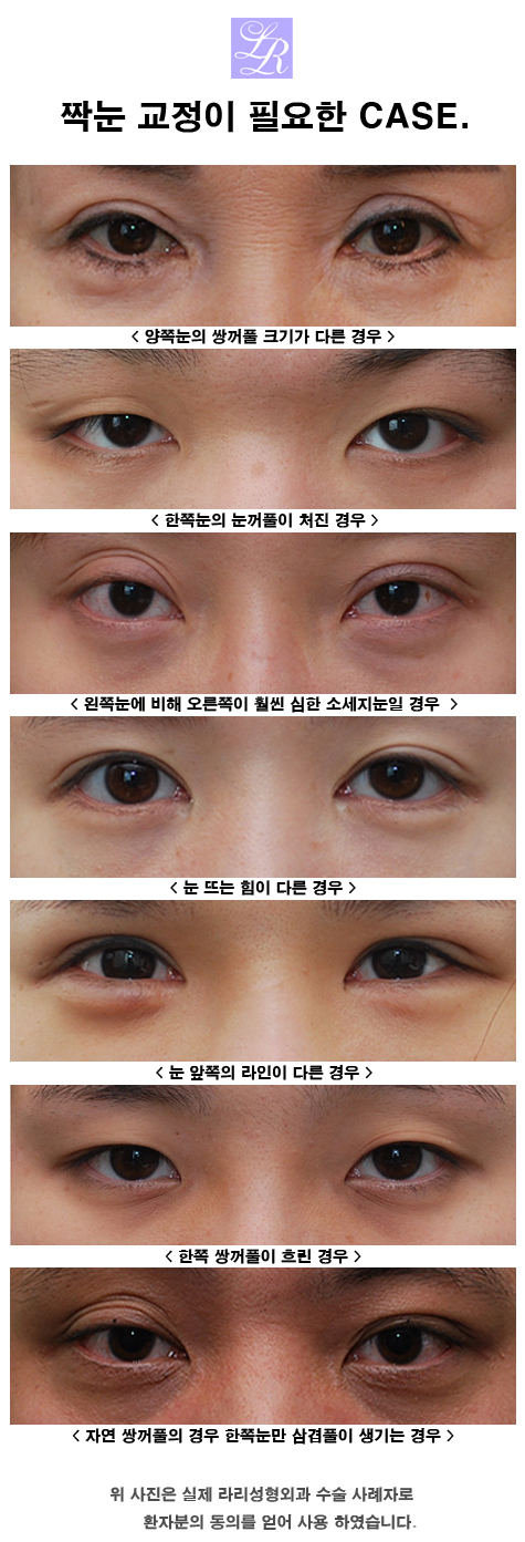 짝눈 수술 - 짝짝이 눈 교정하기 관련 이미지 4