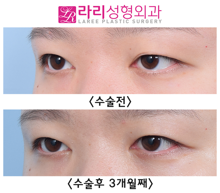 [라리성형외과] 쌍꺼풀없애는수술에 대하여 관련 이미지 2