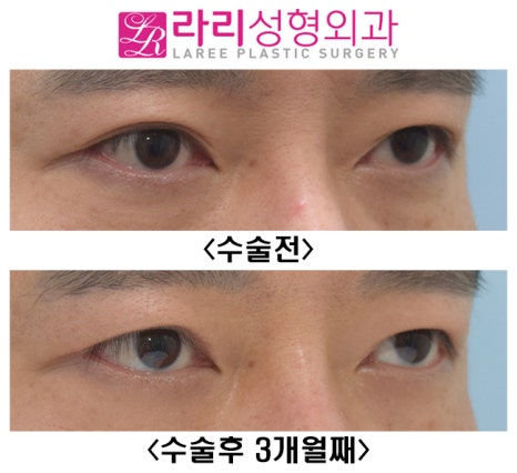 [Lari Plastic Surgery] Surgery to remove double eyelids only removes the double eyelids. image 5