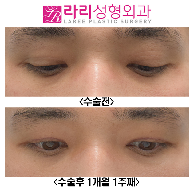 [Lari Plastic Surgery] Before-and-After Photos of Male Ptosis Correction Surgery image 2