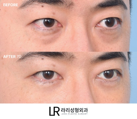 [라리성형외과] 하루(1DAY) 투자로 예뻐지는 라리성형외과의 퀵 눈밑지방재배치수술 관련 이미지 5