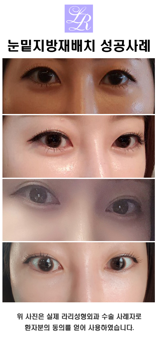 눈밑지방재배치는 눈밑지방제거와 다르다? 관련 이미지 4