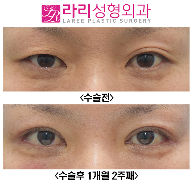 [라리성형외과] 자연스러운 절개눈매교정과 함께한 눈꼬리내리기뒤트임 수술전후 관련 이미지 2