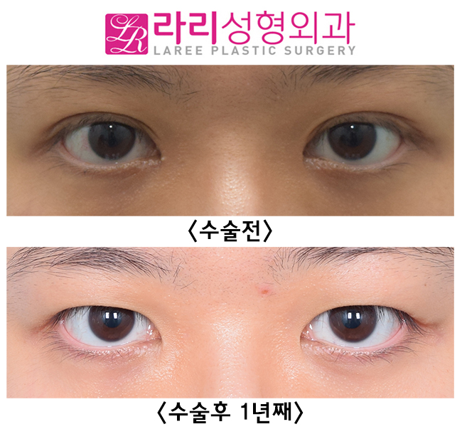 [라리성형외과] 재발률이 낮은 반영구 수술 쌍꺼풀없애기 관련 이미지 1