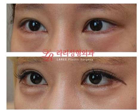 Revision Double Eyelid Surgery, Revision Epicanthoplasty, Under-Eye Fat Repositioning Before and After Photos image 2