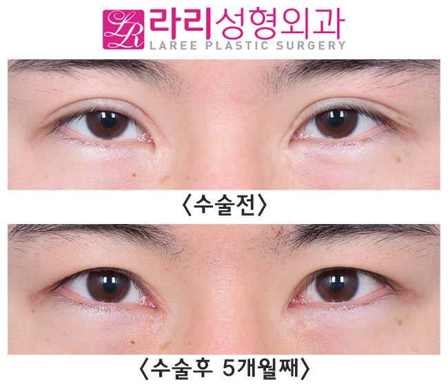 [Lari Plastic Surgery] Removing an Overly Outer-Corner Double Eyelid Line with Epicanthoplasty image 1