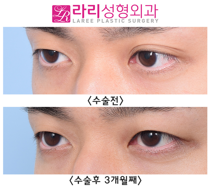 [Lari Plastic Surgery] Removing a Double Eyelid That Formed on Only One Side - Left? Right? Either Is Fine image 3
