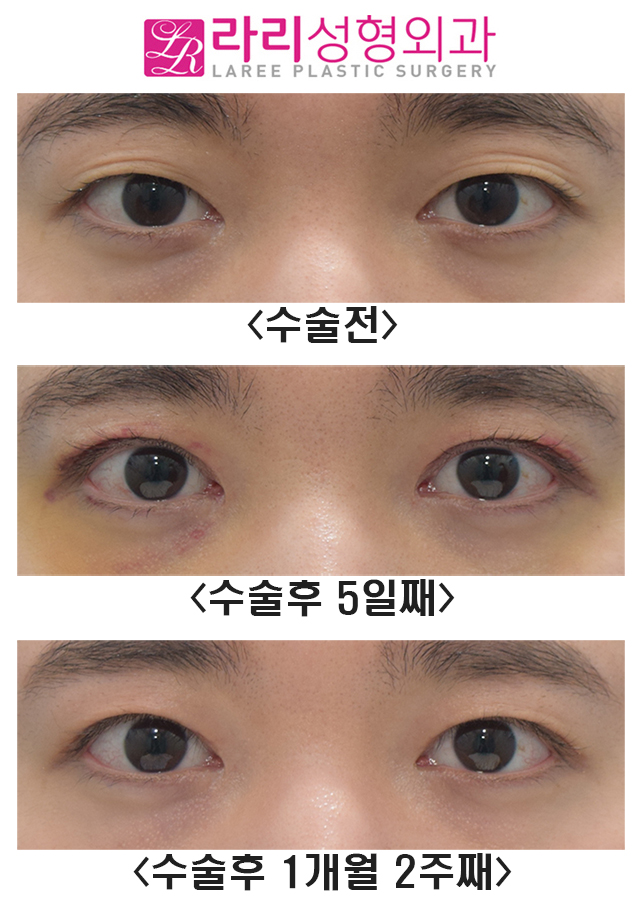 [라리성형외과] 여러겹 쌍꺼풀라인 없애기 관련 이미지 1