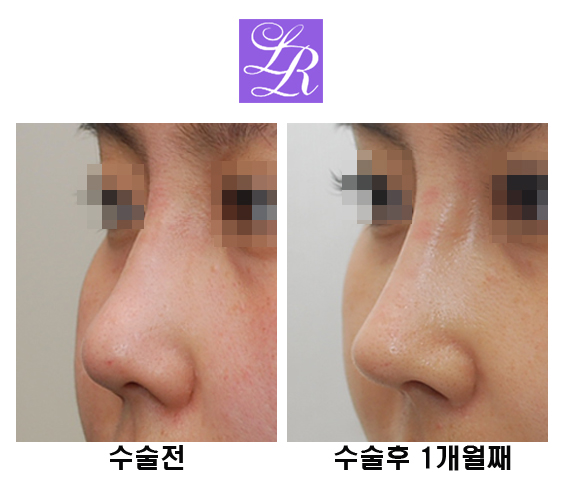 코재수술 코끝을 오똑하게 관련 이미지 2