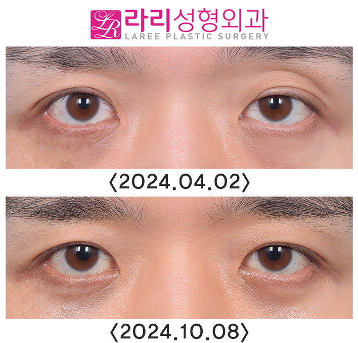 [Lari Plastic Surgery] Double Eyelid Removal Surgery and Upper Eyelid Fat Grafting Surgery: Comparing Recovery and Swelling Over 6 Months image 6